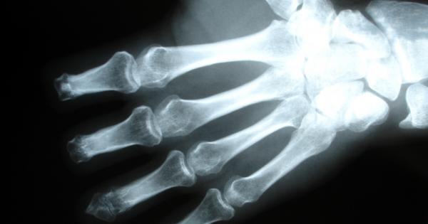 Майка ви винаги ви е казвала да не изпуквате кокалчетата