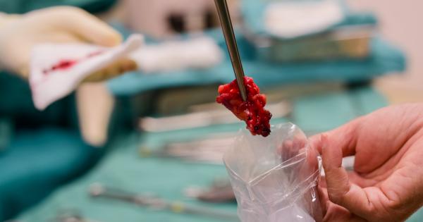 Нова технология за тъканни проби може да замени болезнените и