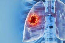 Липсващ раков ген обяснява защо някои тумори на белия дроб реагират добре на имунотерапия