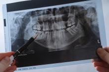 21-годишно проучване свързва пародонтозата и кариесите с повишен риск от инсулт