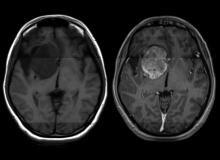 За този смъртоносен рак на мозъка няма лек. Учени обаче откриха как да го преборят
